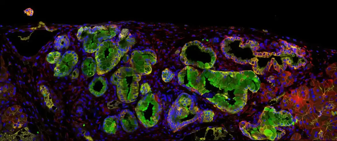Antibakterijski protein pruža novu terapijsku metu protiv raka pankreasa