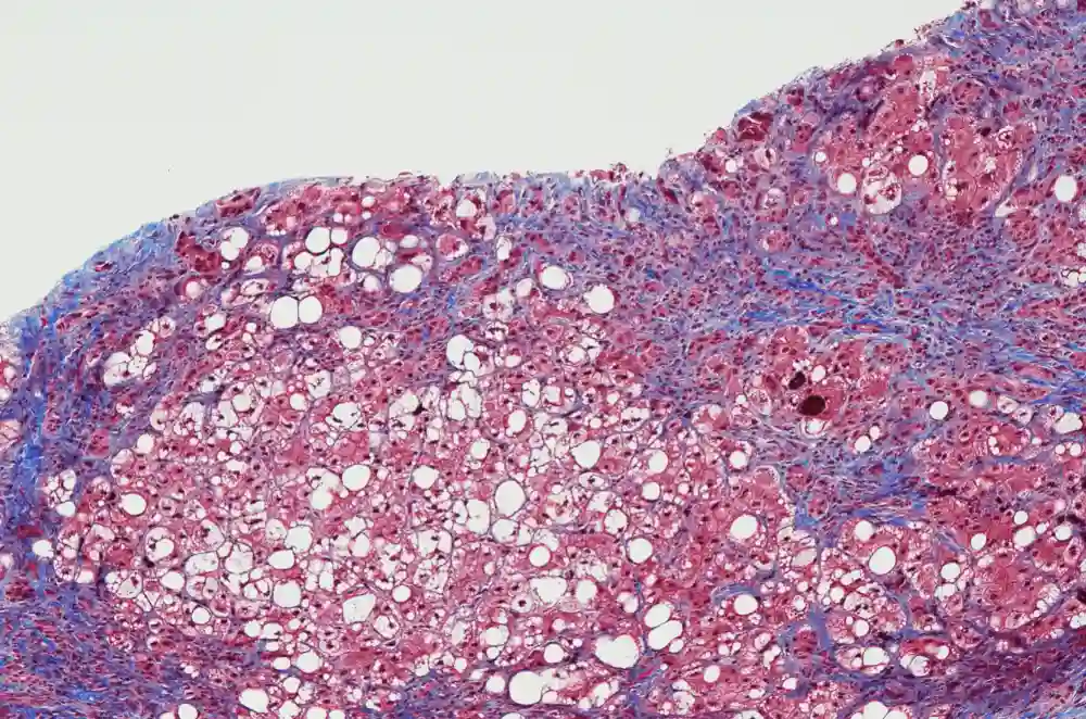 Istraživači navode kako se ćelije aktiviraju da izazovu fibrozu i ožiljke organa