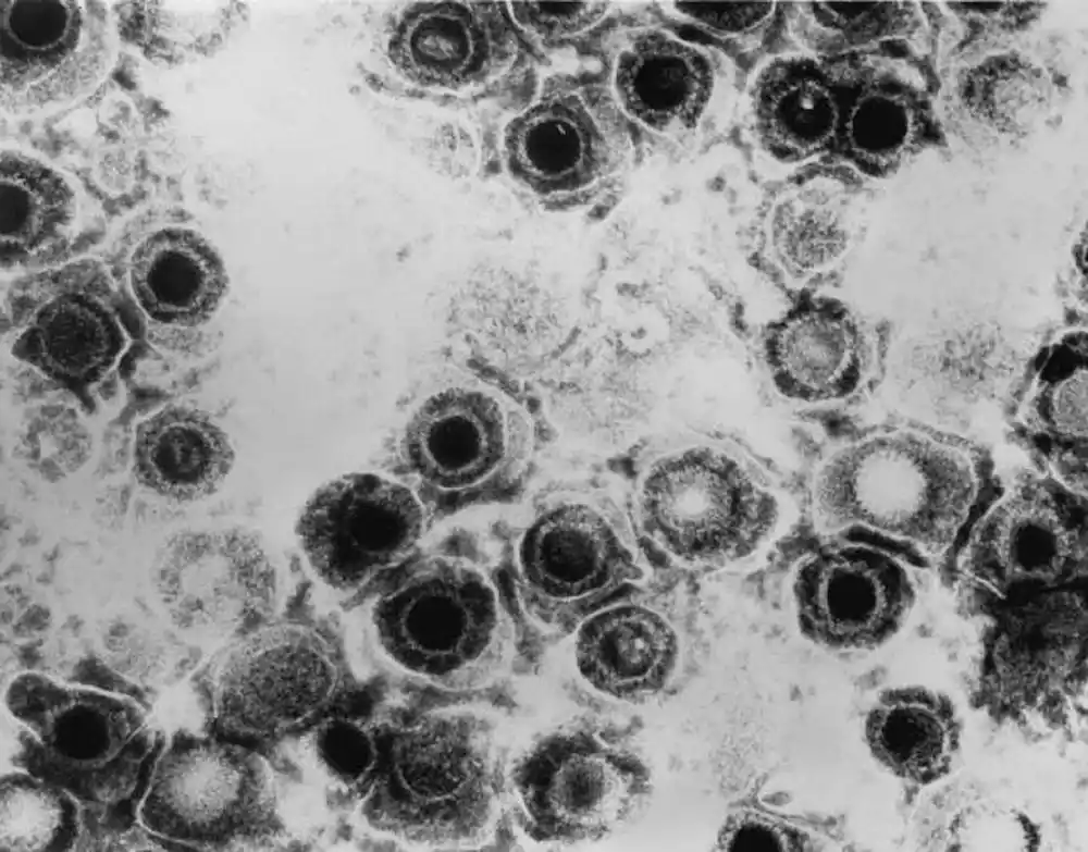 Kako virusi herpesa infiltriraju nervni sistem