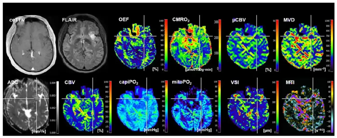 Metoda mašinskog učenja za predviđanje mutacija glioma obećava personalizovani tretman