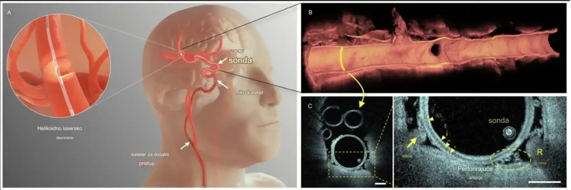 Minijaturna sonda za optičku koherentnu tomografiju snima slike unutar cerebralnih arterija