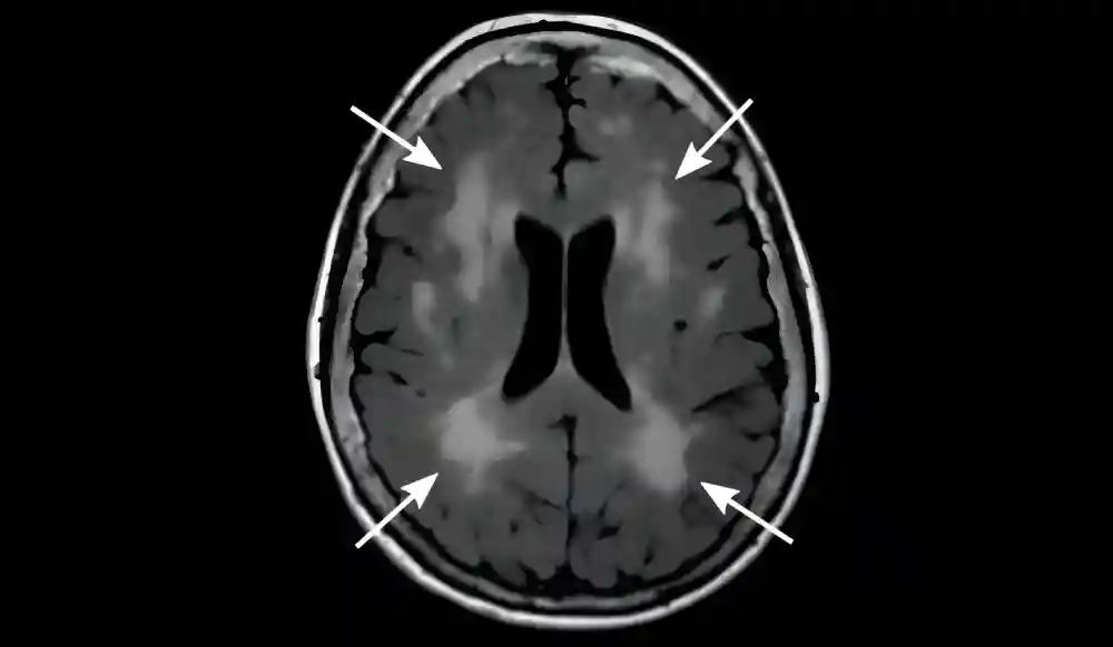 Nova studija otkriva da promene mozga povezane sa uzrastom utiču na oporavak nakon moždanog udara