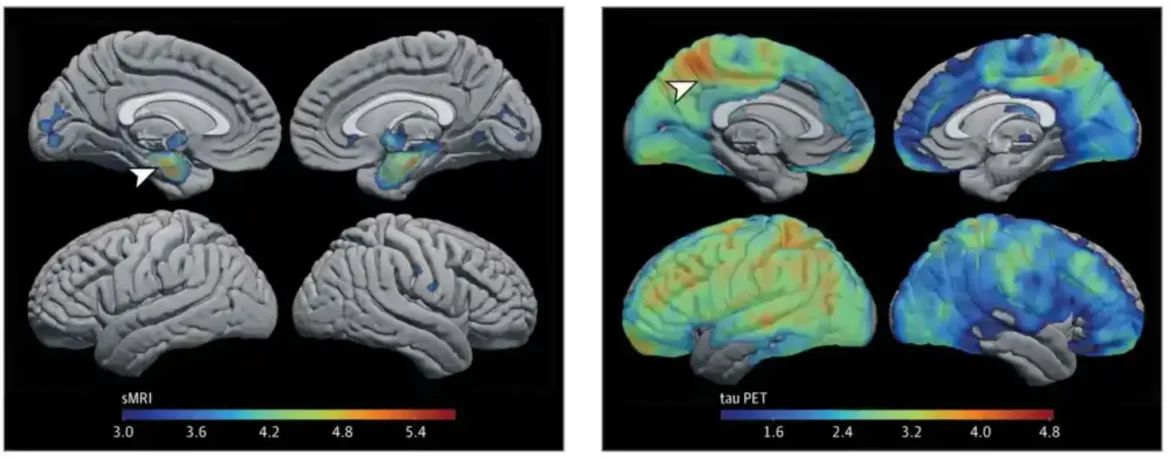 Novi alat povezuje tipove Alchajmerove bolesti sa stopom kognitivnog pada