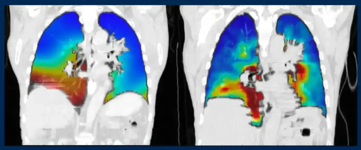 Novi softver za snimanje poboljšava dijagnozu pluća za 30% pacijenata koji ne mogu tolerisati kontrastnu boju