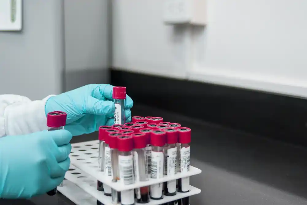 Novi test krvi za otkrivanje moždanog udara kombinuje biomarkere na bazi krvi sa kliničkim rezultatom