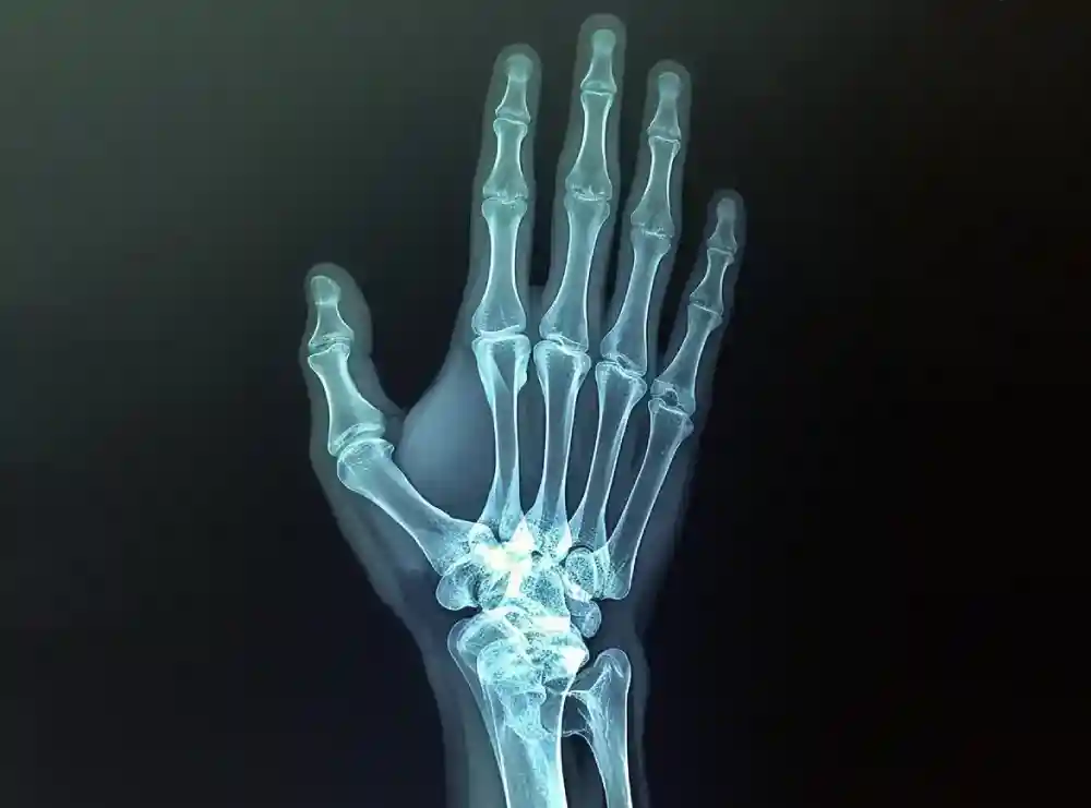 Studija daje uputstva lekarima za individualni tretman preloma ručnog zgloba