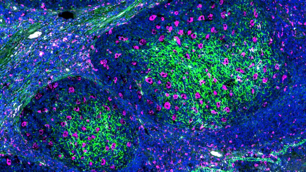 Varijacije u ‘drevnim’ imunim ćelijama povezane sa preživljavanjem pacijenata kod raka