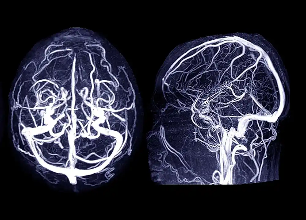 Šta je cerebralna aneurizma i koji su znaci?