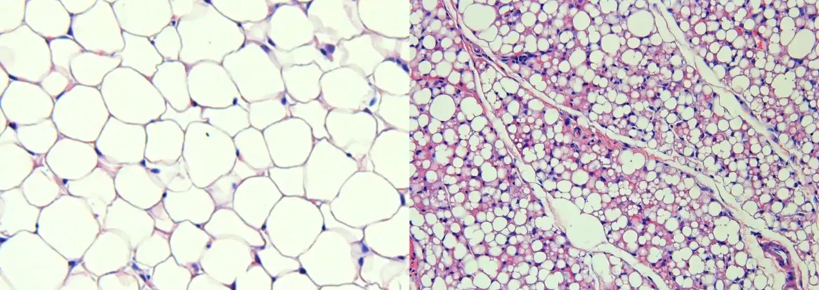 Studija otkriva ulogu smeđe masti u zaštiti metabolizma šećera u krvi