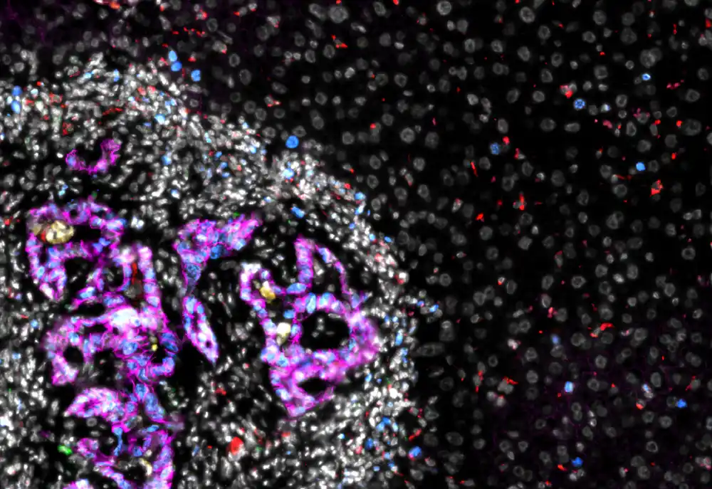 Istraživači otkrivaju kako ćelije kolorektalnog raka kolonizuju jetru