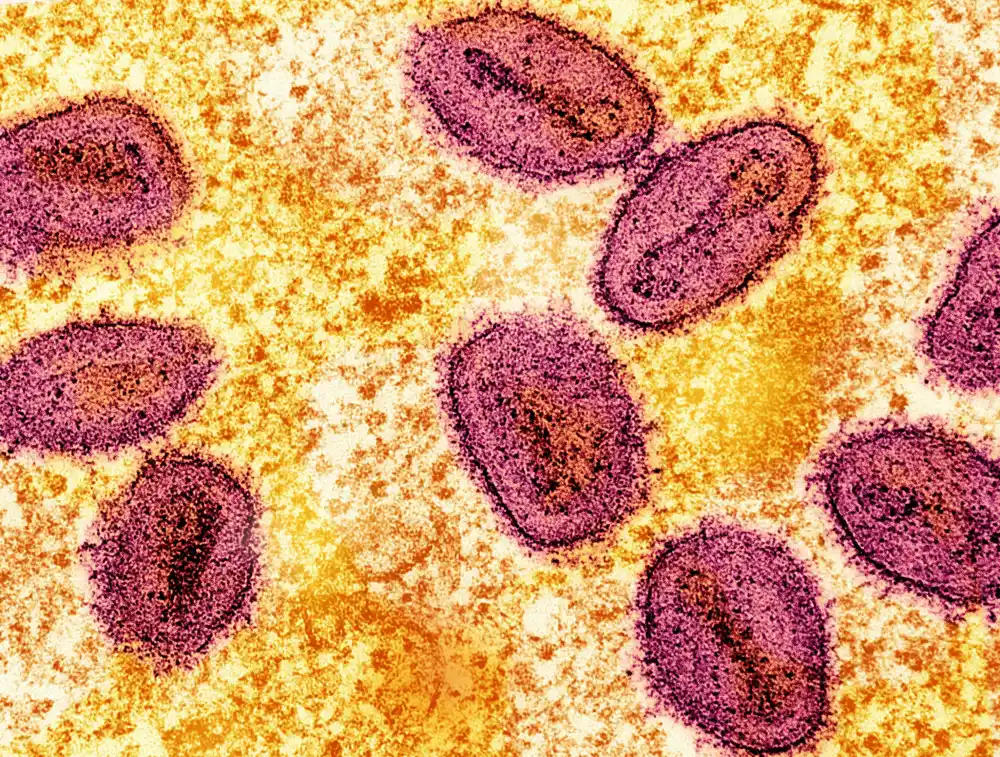 Epidemija mpoksa u Africi je zanemarena – sada bi se mogla pretvoriti u sledeću globalnu pandemiju