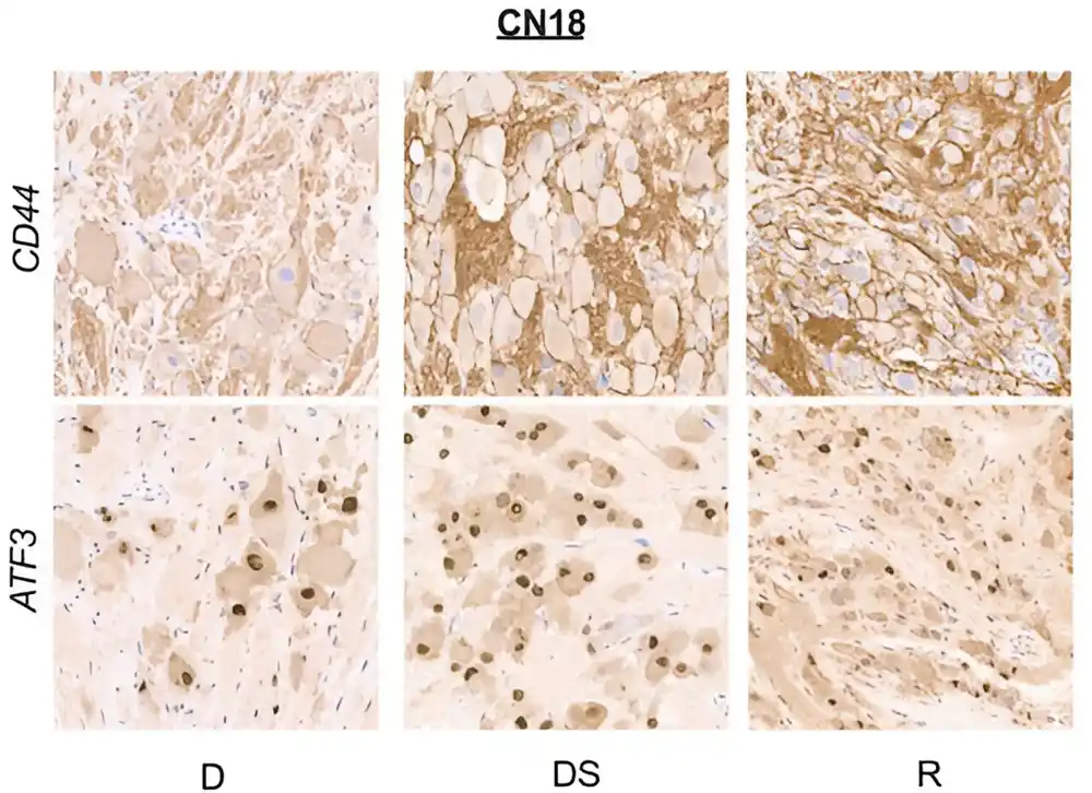 Istraživači identifikuju maligne ćelije odgovorne za recidiv neuroblastoma visokog rizika