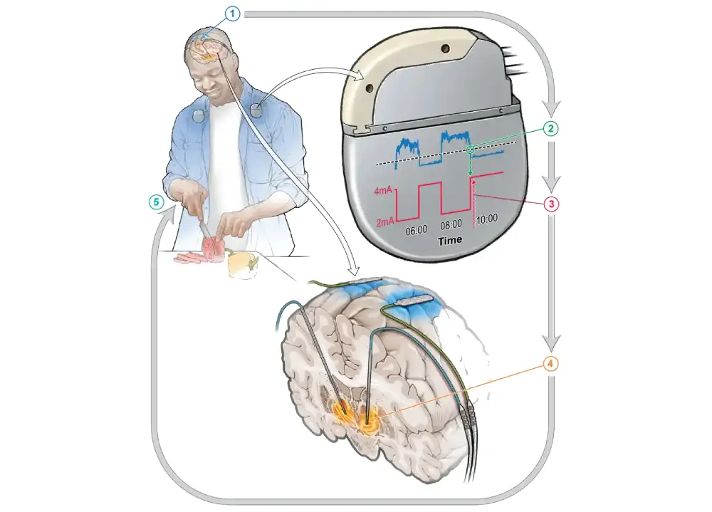 Inovativna terapija za Parkinsonovu bolest: Adaptivna duboka moždana stimulacija nudi novo rešenje za kontrolu simptoma