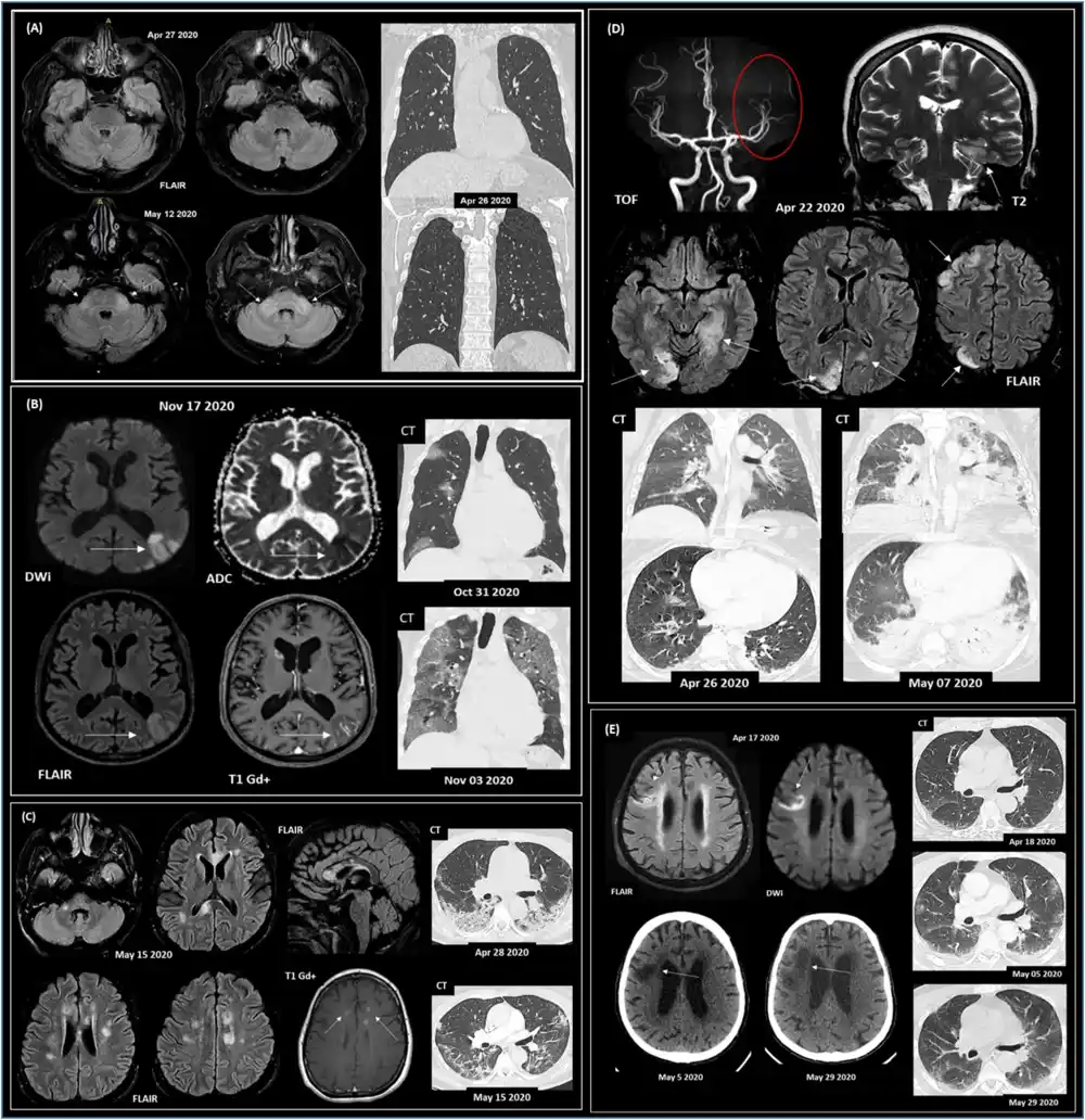 Upala može povezati težinu COVID-19 sa pojavom neuroloških simptoma