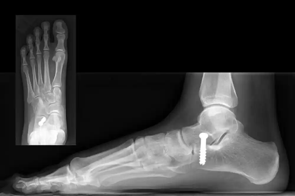 Nova procedura može premostiti jaz u lečenju simptomatskog fleksibilnog ravnog stopala