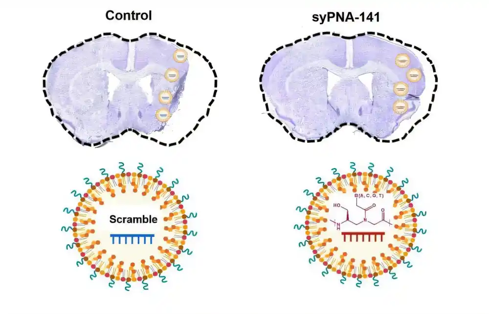 Novi inhibitor miRNA mogao bi ugasiti „zapaljenu vatru“ koju moždani udar izaziva u mozgu