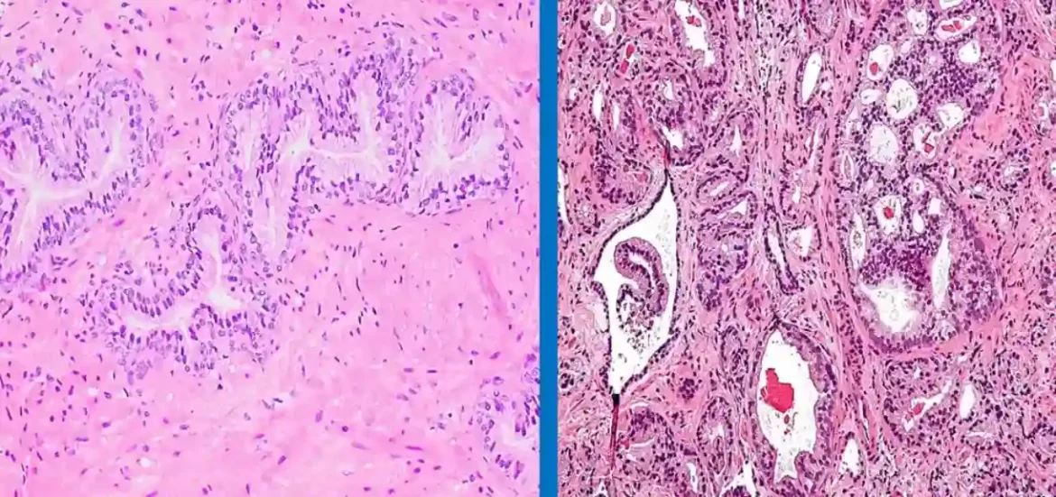 Zdrava ishrana može pomoći u sprečavanju napredovanja raka prostate