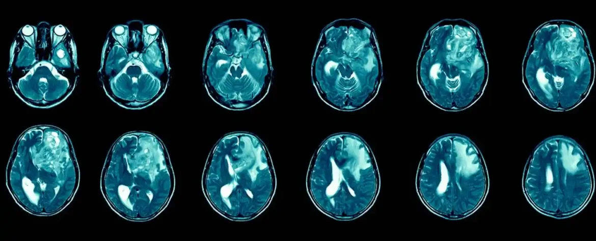 Imunoterapija nudi nadu u borbi protiv smrtonosnog glioblastoma