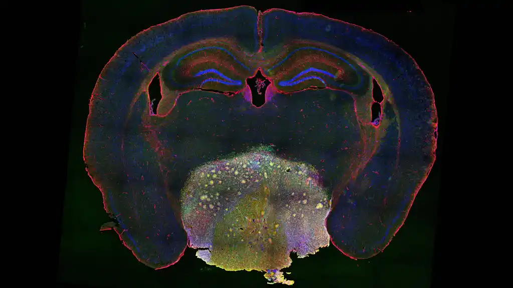 Kineski istraživači identifikovali potencijalni lek za benigni tumor koji napada kritične strukture mozga